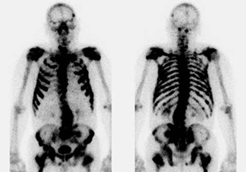 Skelettszintigraphie mit 717 MBq Tc-99m-MDP, metastasierendes Prostatakarzinom mit multiplen osteoblastischen Knochenmetastasen